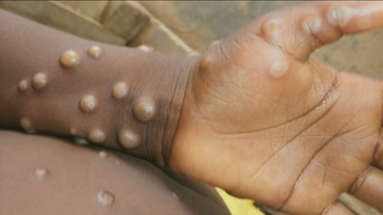 Monkeypox incidence expected to rise in UK after first Scottish case