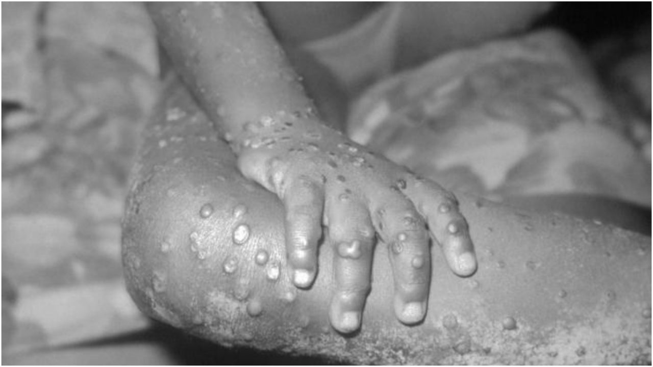 Four more UK monkeypox cases confirmed as total number of infections rises to seven
