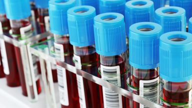 Galleri blood test ‘feasible at scale’ on NHS, say experts