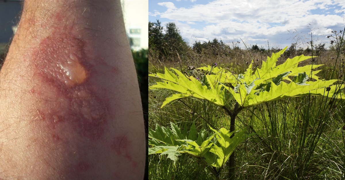 Scots warned of giant hogweed plant that can cause blisters, burns and blindness as school holidays start