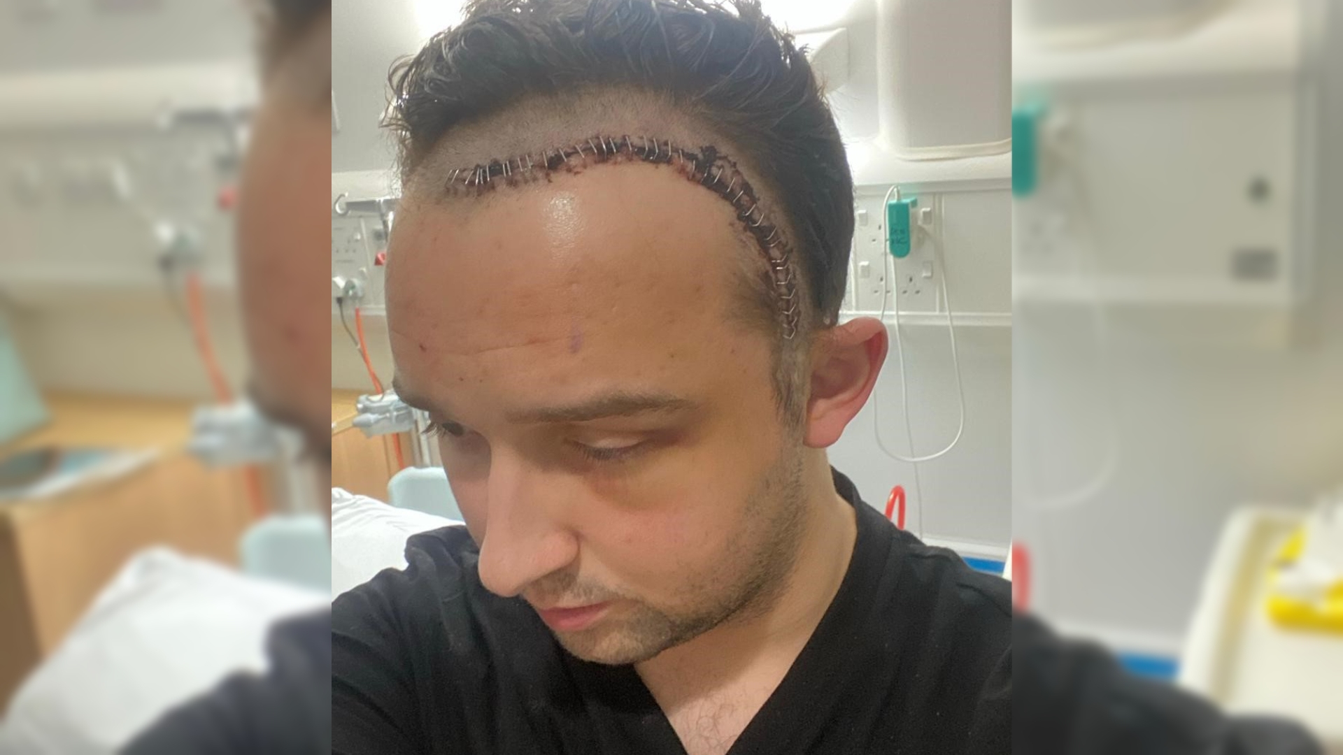 Last November he underwent an awake craniotomy in which more than 90% of the tumour was removed.