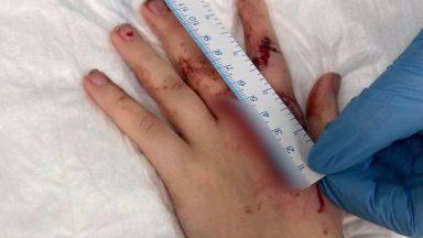 Teenager scared to leave house after friend’s dog bit hand in Kirkcaldy house