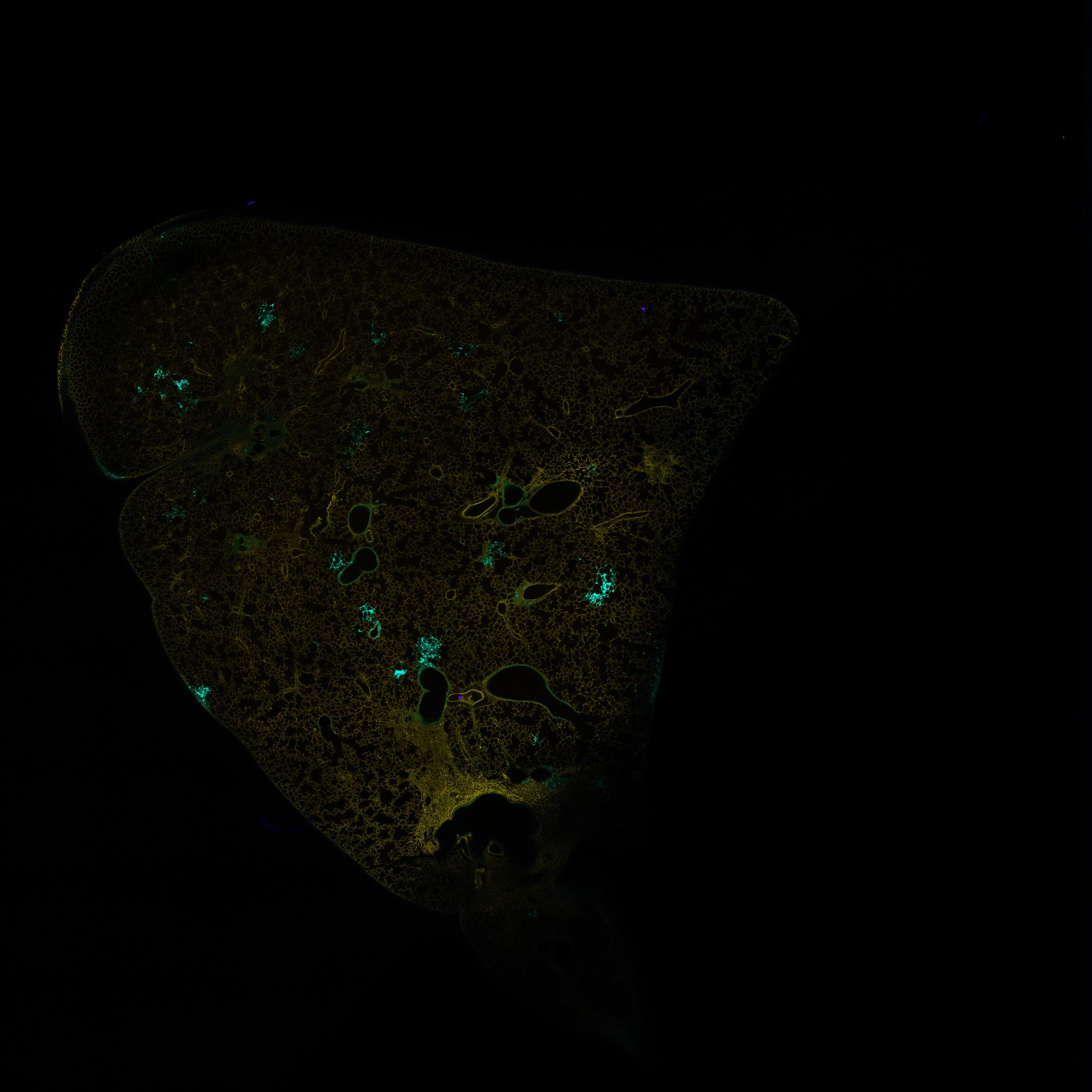 Skin cancer which has spread to the lung.