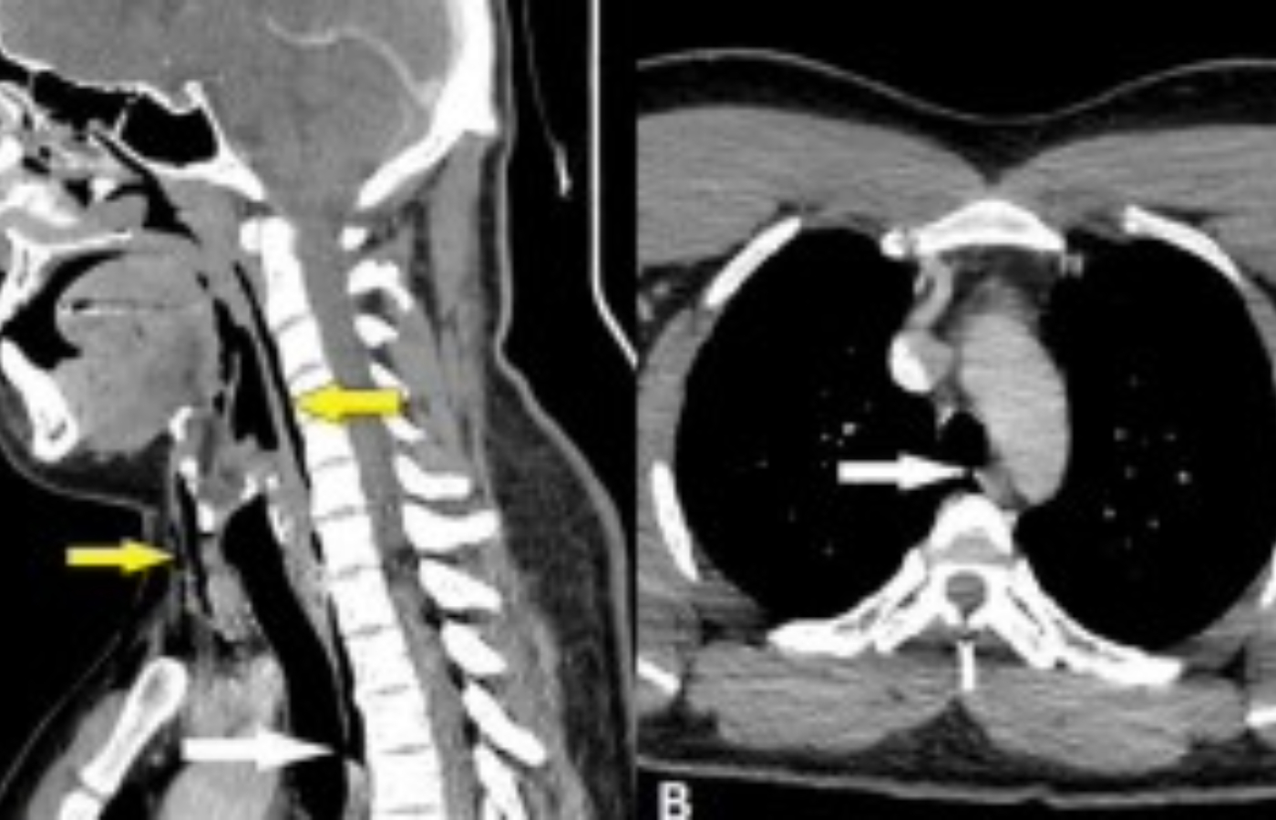 Scans revealed a 2mm perforation in the patient's windpipe.