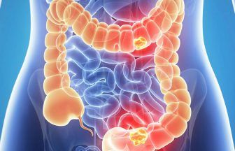 Scientists examining role of DNA in development of bowel cancer