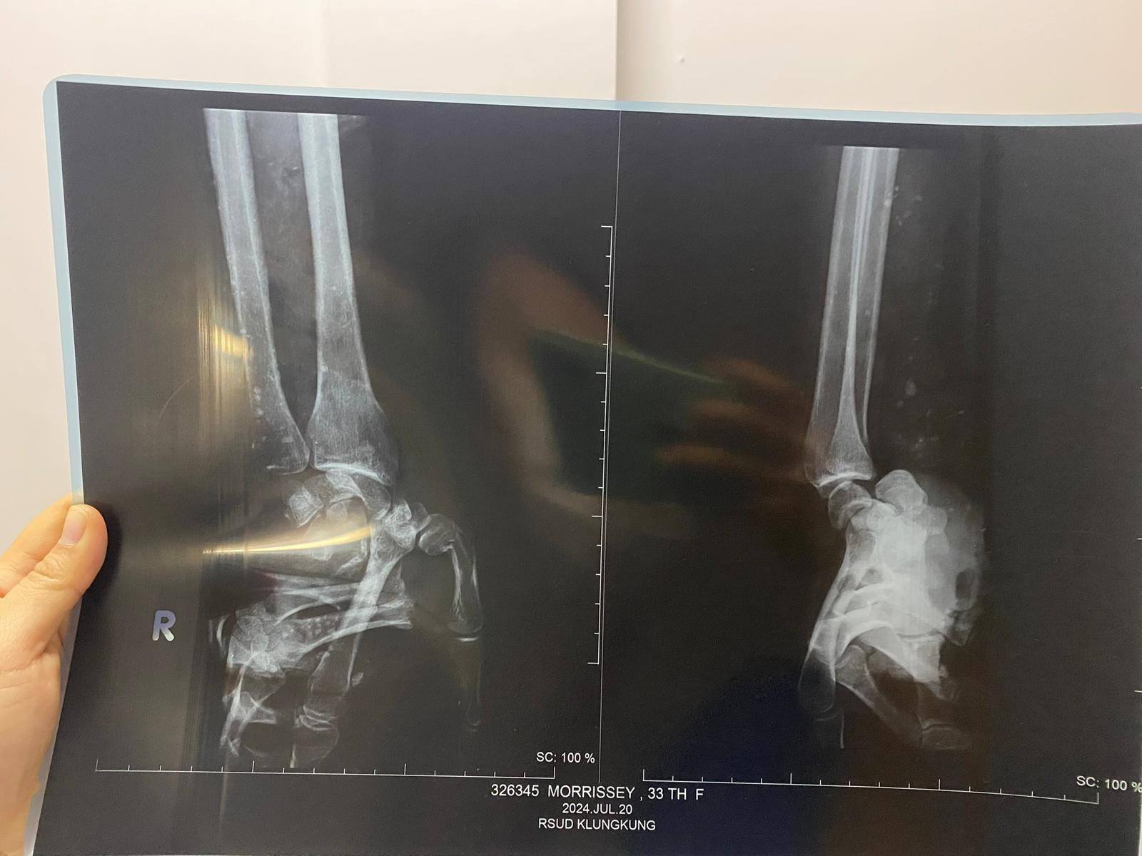 X-ray shows bones in Charlene's right hand 'crushed' after crash.