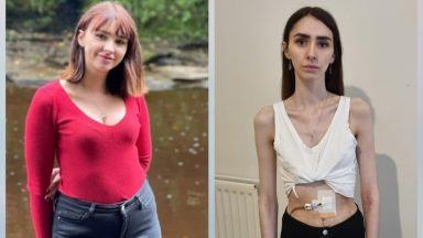 Student lost half her body weight in months after ‘stomach was paralysed’