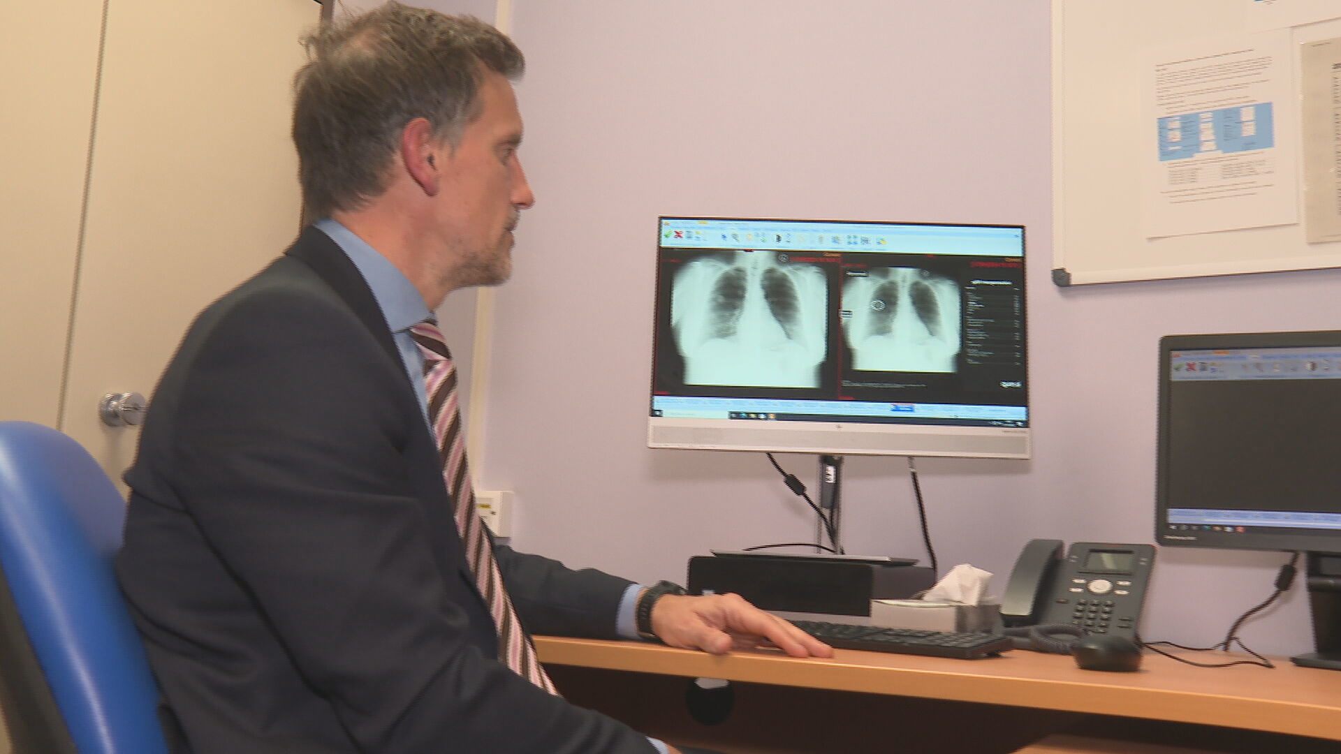 Dr John Maclay treated Diane after lung cancer was detected using new software