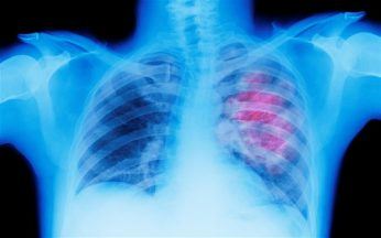 St Andrews University: Lung cancer trial reveals 40% drop in deaths using biomarker testing