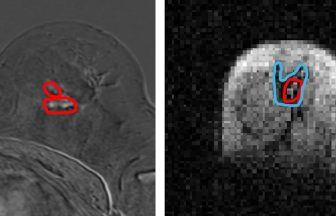 World-first technology developed at University of Aberdeen can see ‘previously undetectable’ cancer spread