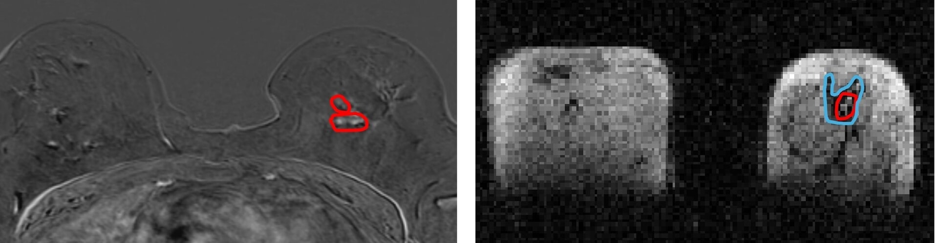 (Left) MRI image of breast with cancerous tumours circled in red (right) FCI image of same breast shows same tumour in red with secondary tumour spread in blue.