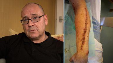 Helensburgh man ‘trapped in own home’ after NHS cancel reconstructive surgery multiple times