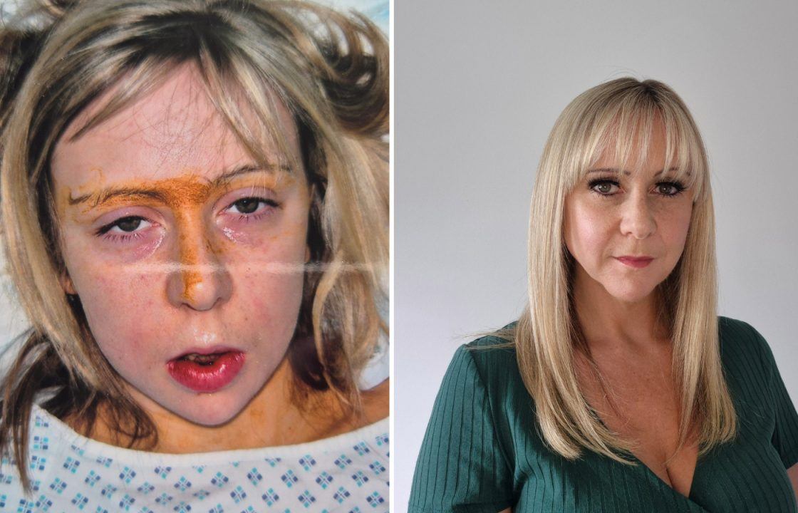 Aberdeen mum ‘given her life back’ after bike accident stopped jaw growing aged ten