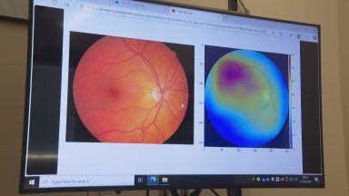 Researchers using AI to detect heart health issues in eye scans