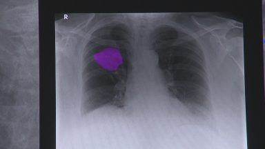 NHS Grampian ‘paving the way’ for AI lung cancer detection