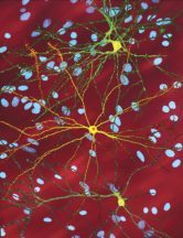 Charity hails breakthrough Huntington’s disease treatment amid high rates of the disease in north Scotland