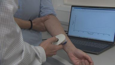 ‘Revolutionary’ skin sensor could change how eczema is treated