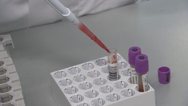 NHS Grampian first to introduce routine HIV and Hepatitis testing