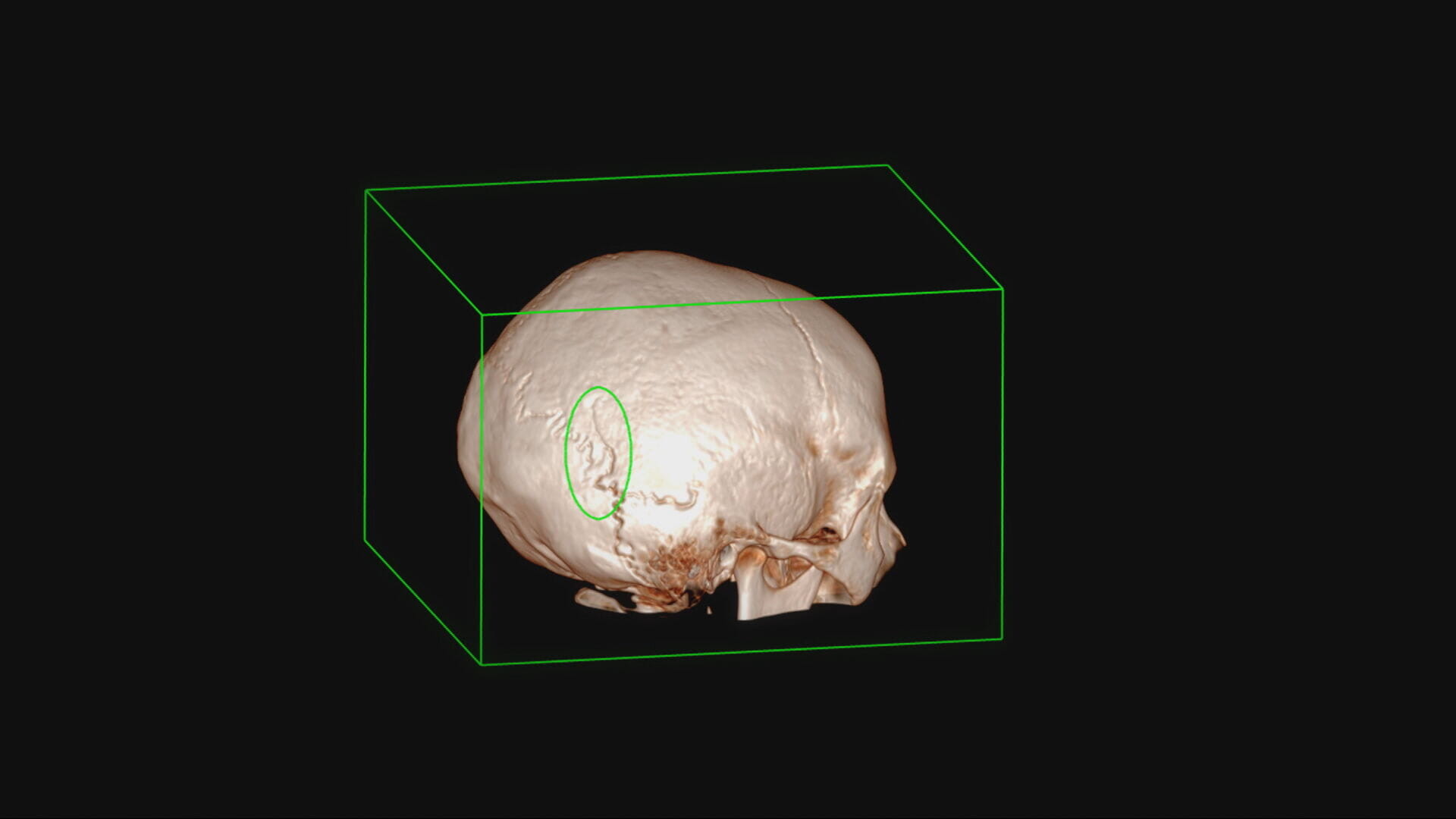 Medics have seen brain and head injuries caused by e-scooters