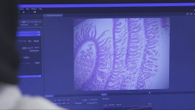 Scotland Tonight: New Glasgow pilot aims to speed up bowel cancer diagnosis