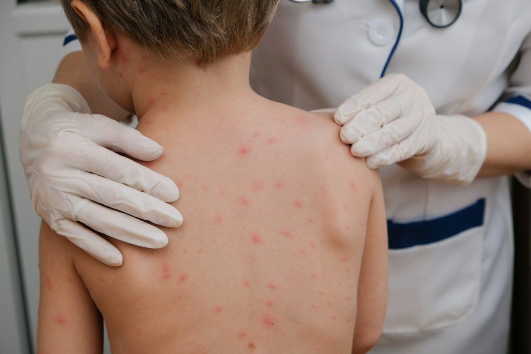 Chickenpox vaccine to be rolled out on NHS for first time