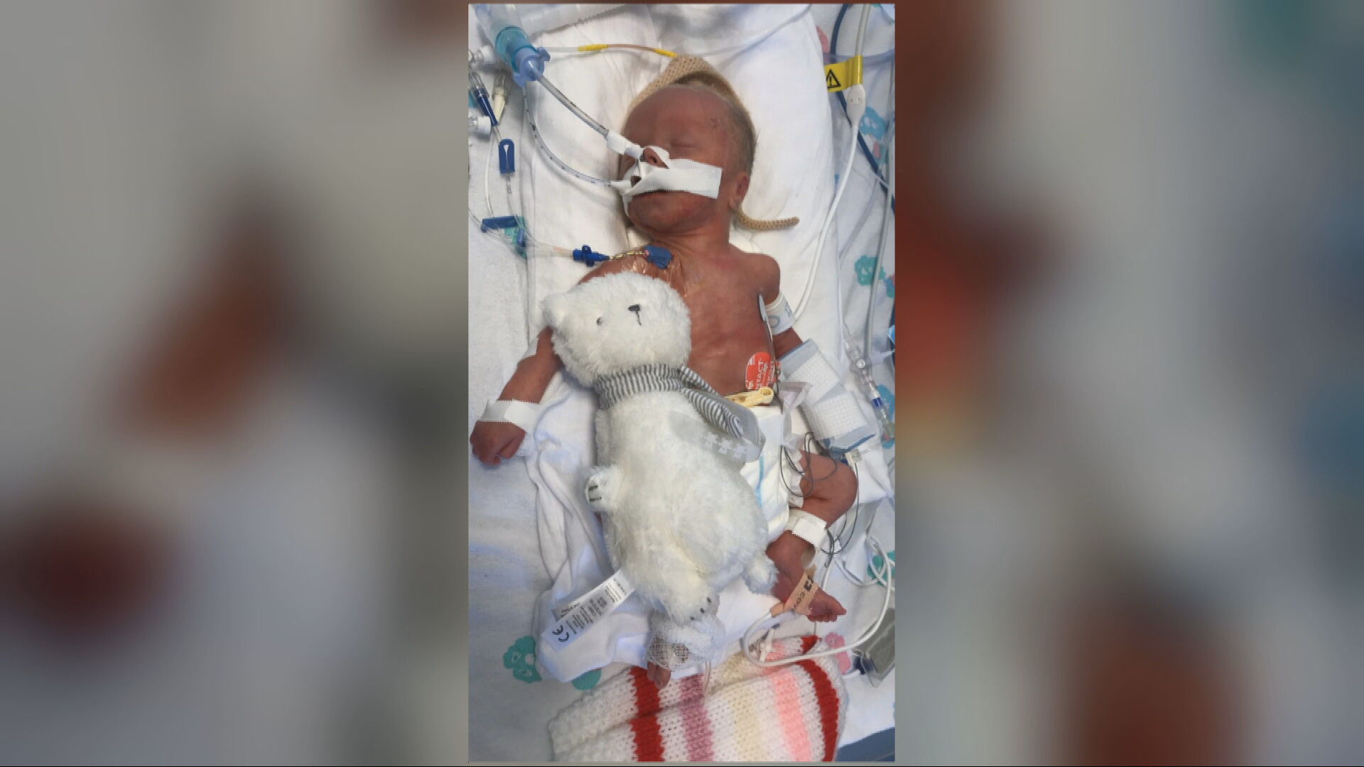 Noah was born with a rare birth defect