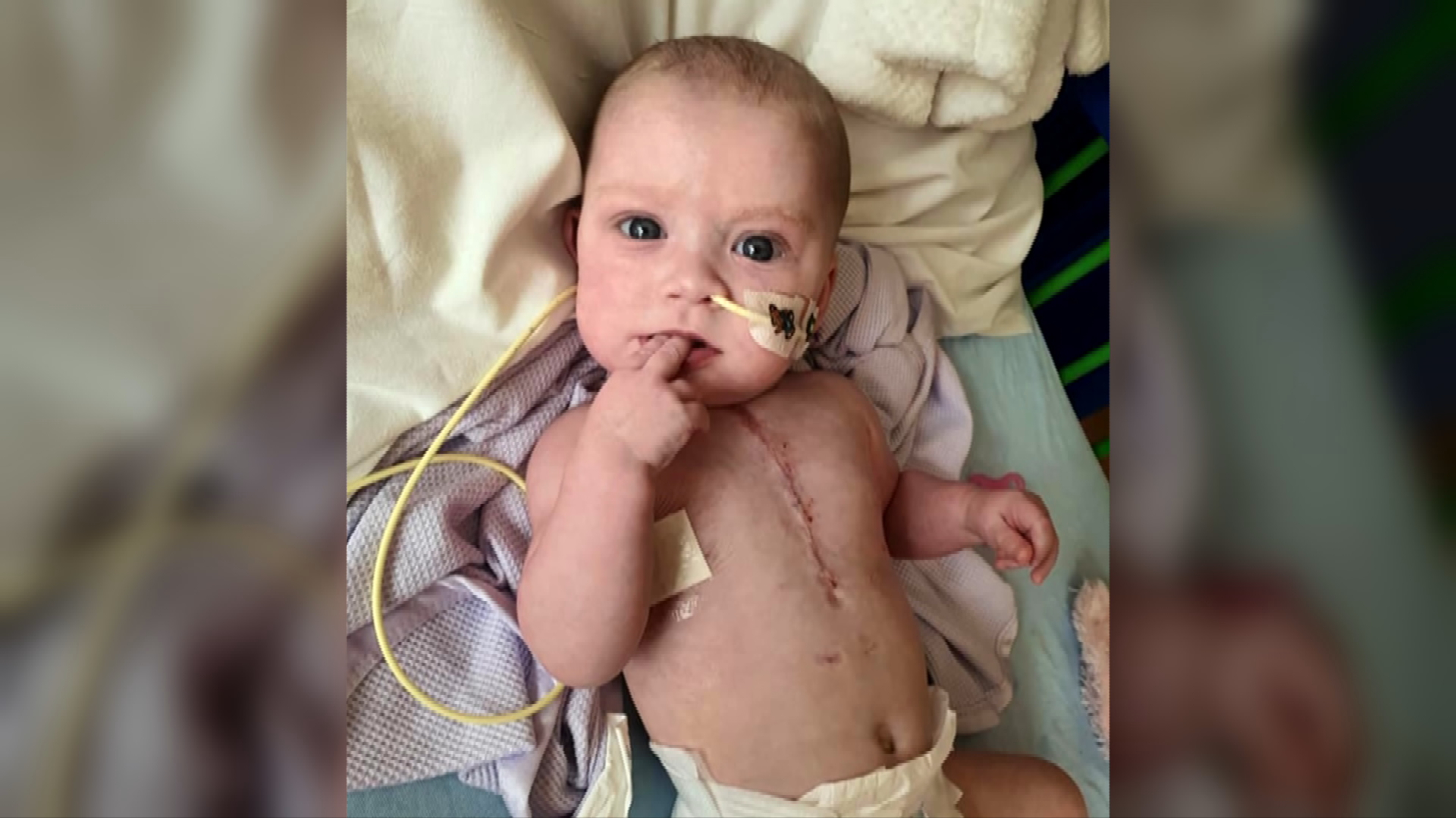 Annabelle underwent several surgeries in her first months of life