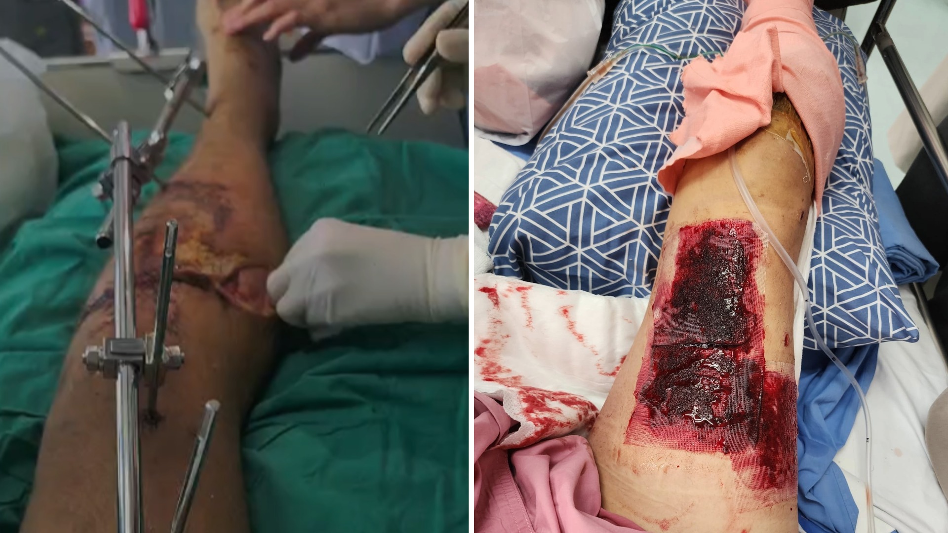 Darren Cummins may never walk again after a motorbike crash in Thailand.