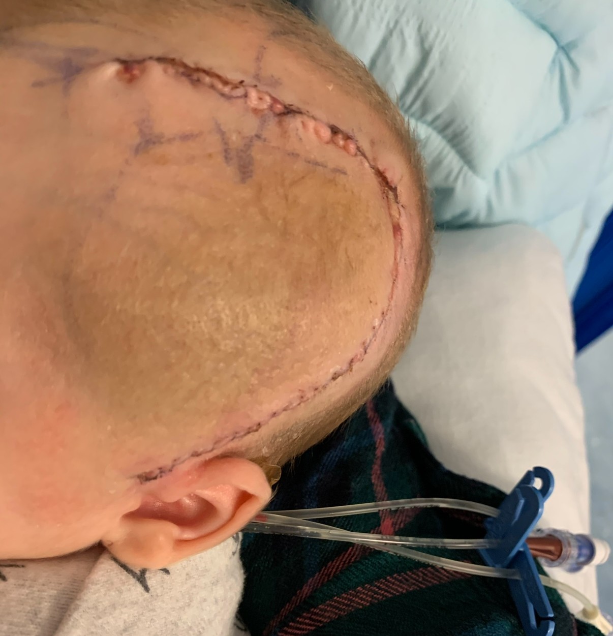 Joey’s surgery scar